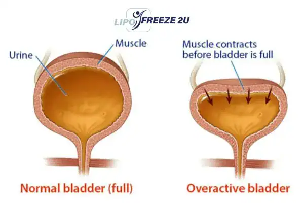 diagram of overactive bladder treatment Fleet