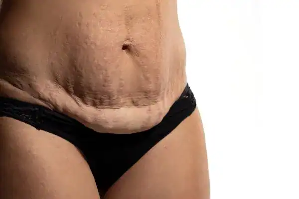 loose skin after weight loss injections Fleet