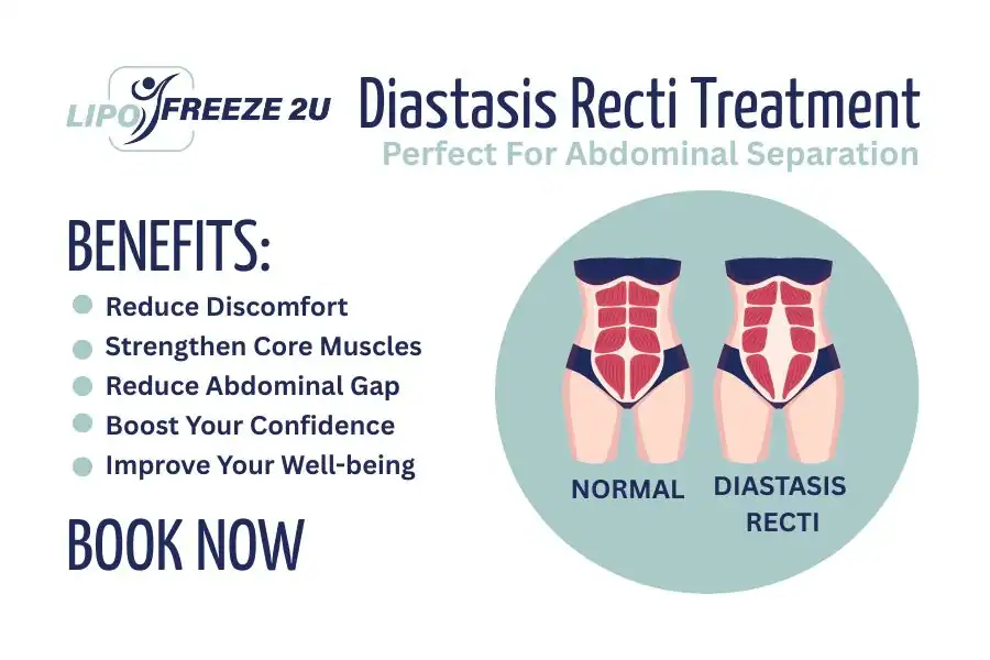 Benefits of body toning treatment Fleet for Diastasis recti