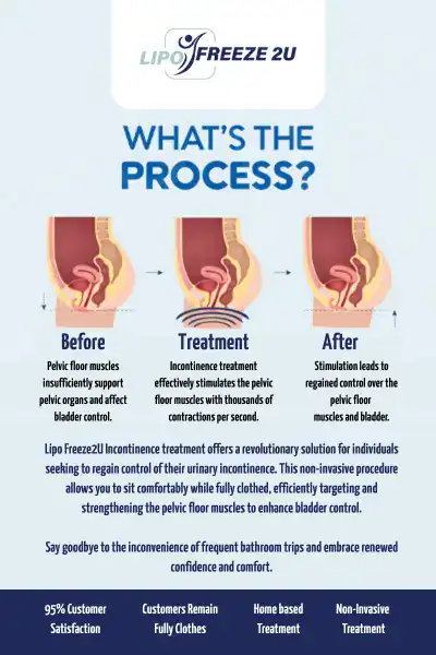 Diagram of how incontinence treatment Fleet works.