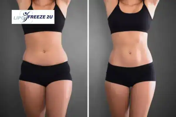 How Can LIPO FREEZE 2U Support Your Post-Pregnancy Body Recovery Fleet?