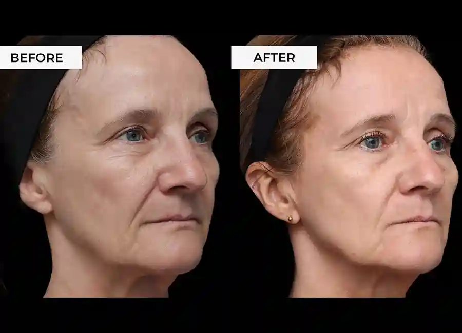 How Many RF Microneedling Sessions Will You Need to See a Difference Fleet?