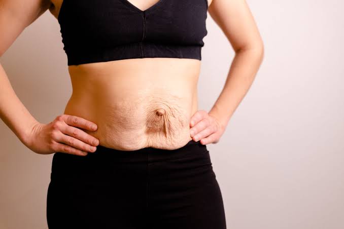 Is Surgery Really the Only Way to Repair Diastasis Recti Fleet?