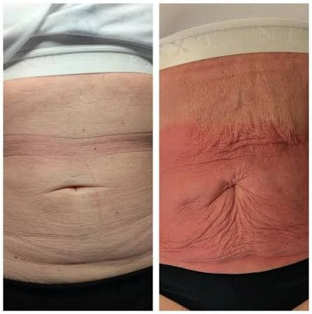 How Does RF Microneedling Improve Crepey, Thin and Uneven Skin Texture Fleet?