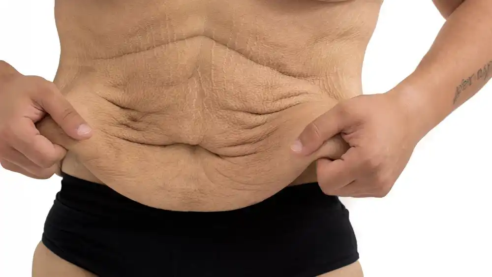 RF Microneedling for Loose Skin: How Can It Help Tighten and Reshape the Skin Fleet?